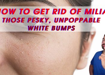 How to Get Rid of Milia, Those Pesky, Unpoppable White Bumps