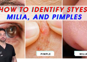 How to Identify Styes, Milia, and Pimples