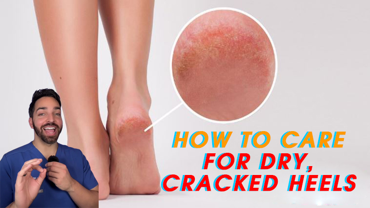 How to Care for Dry, Cracked Heels How to Care for Dry, Cracked Heels